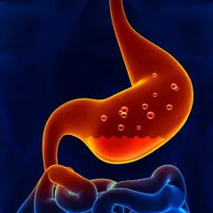 Stomaco infiammato con bolle, un'illustrazione che mostra come sono guarito dalla gastrite.