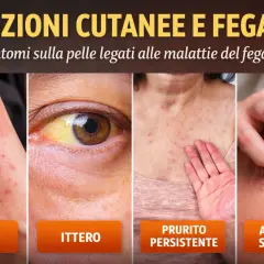 Eruzioni cutanee e ittero: macchie rosse, prurito persistente e angiomi stellati sono possibili sintomi di un fegato intossicato.