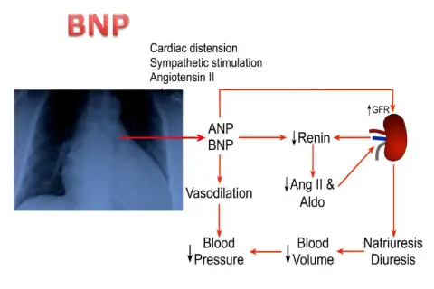 Schema che illustra il ruolo del peptide natriuretico tipo b (BNP) nella regolazione della pressione sanguigna e del volume ematico, con un rx torace a sinistra.