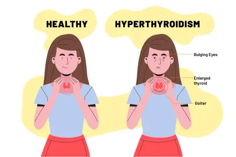 Confronto tra tiroide sana e ipertiroidismo: occhi sporgenti, tiroide ingrossata e gozzo indicano quando gli anticorpi anti-tireoperossidasi alti sono motivo di preoccupazione.