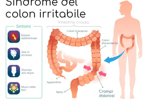 Illustrazione della sindrome del colon irritabile con sintomi: dolore addominale, gas, diarrea/stipsi, muco. Una dieta depurativa colon irritabile può aiutare.
