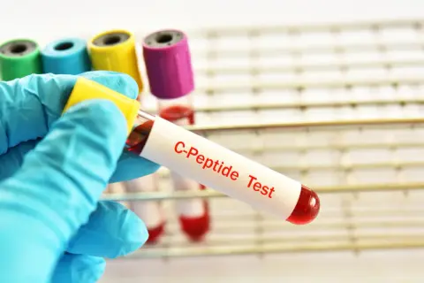 Tubo da test con etichetta "C-Peptide Test" e campione di sangue rosso, pronto per analisi. Un valore di peptide c alto può indicare problemi di salute.