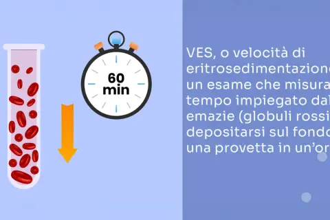 VES, esame sangue: globuli rossi in provetta e cronometro segnano 60 min, indicando il tempo di sedimentazione.