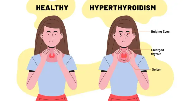 Confronto tra tiroide sana e ipertiroidismo: occhi sporgenti, tiroide ingrossata e gozzo indicano quando gli anticorpi anti-tireoperossidasi alti sono motivo di preoccupazione.