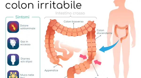 Illustrazione della sindrome del colon irritabile con sintomi: dolore addominale, gas, diarrea/stipsi, muco. Una dieta depurativa colon irritabile può aiutare.