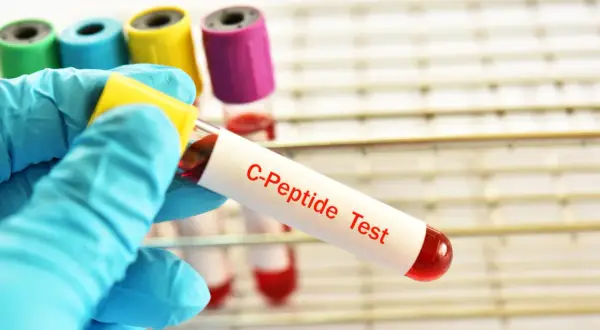 Tubo da test con etichetta "C-Peptide Test" e campione di sangue rosso, pronto per analisi. Un valore di peptide c alto può indicare problemi di salute.