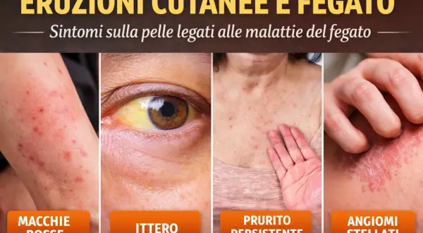 Eruzioni cutanee e ittero: macchie rosse, prurito persistente e angiomi stellati sono possibili sintomi di un fegato intossicato.
