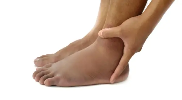Piedi gonfi, un segno che potrebbe indicare problemi al fegato. La mano preme sulla caviglia per valutare il gonfiore.
