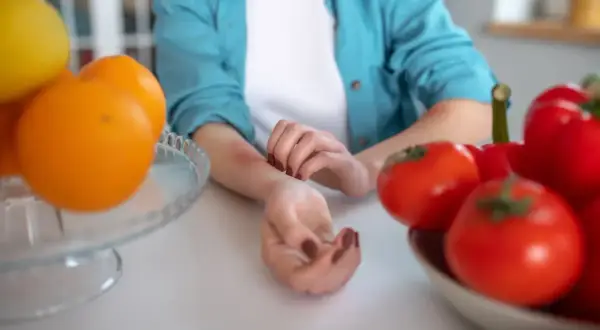 Donna si gratta il braccio arrossato, circondata da frutta e verdura, suggerendo una dieta disintossicante per orticaria.