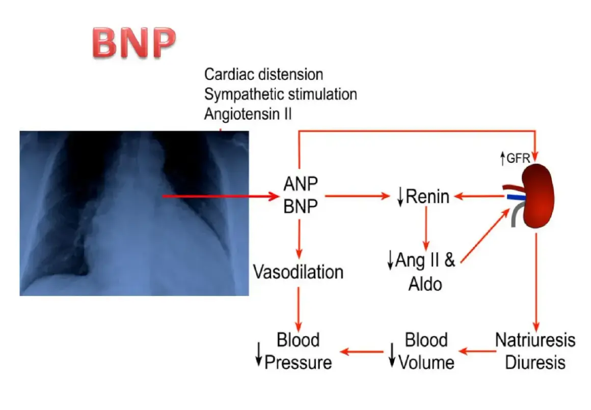 Schema che illustra il ruolo del peptide natriuretico tipo b (BNP) nella regolazione della pressione sanguigna e del volume ematico, con un rx torace a sinistra.