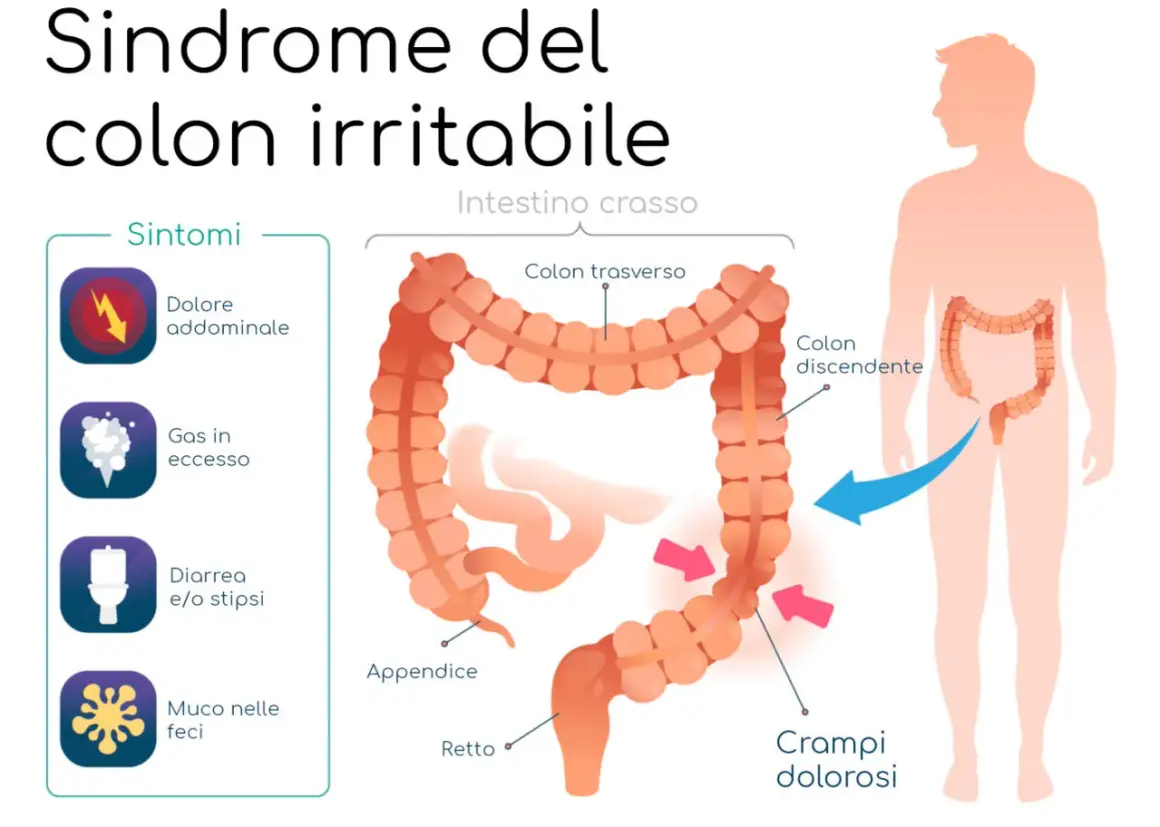 Illustrazione della sindrome del colon irritabile con sintomi: dolore addominale, gas, diarrea/stipsi, muco. Una dieta depurativa colon irritabile può aiutare.