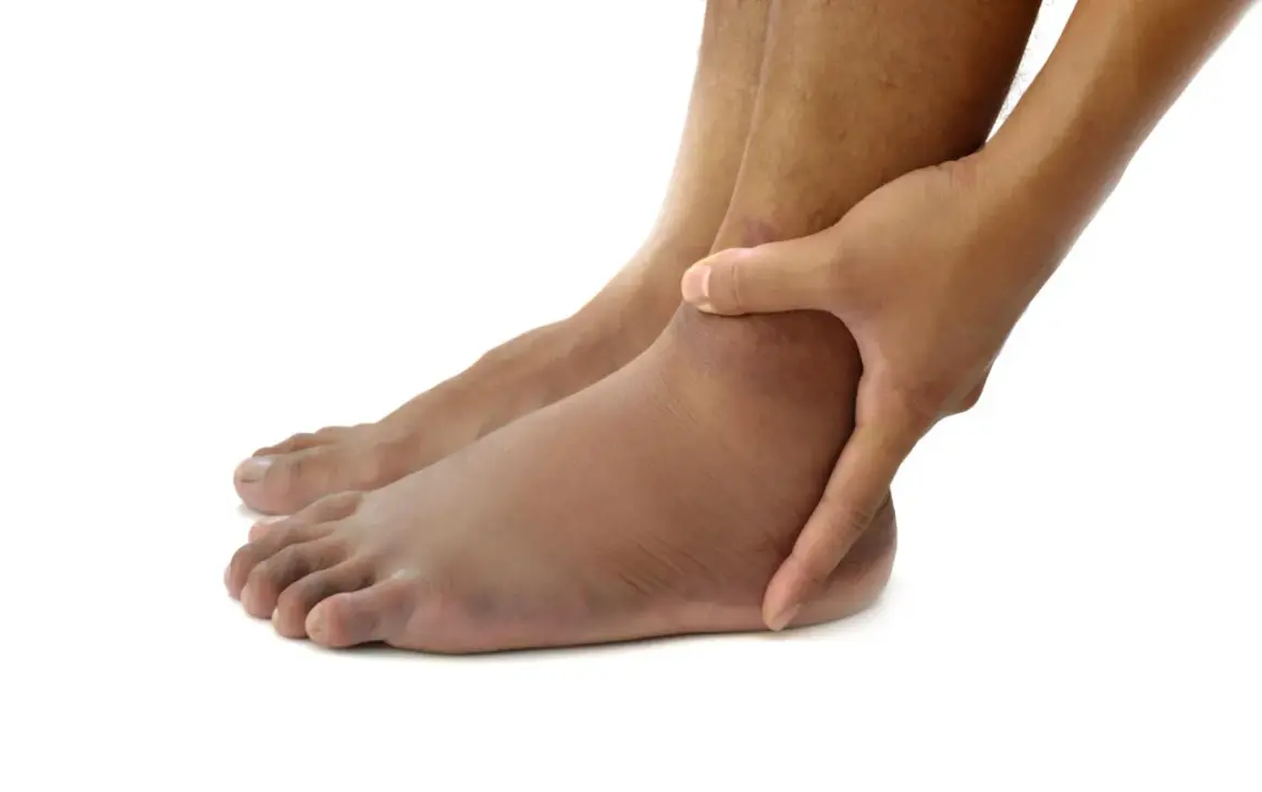 Piedi gonfi, un segno che potrebbe indicare problemi al fegato. La mano preme sulla caviglia per valutare il gonfiore.