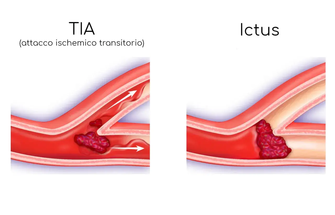 TIA: un coagulo blocca temporaneamente il flusso sanguigno, un sintomo premonitore. Ictus: il coagulo blocca il flusso in modo permanente.