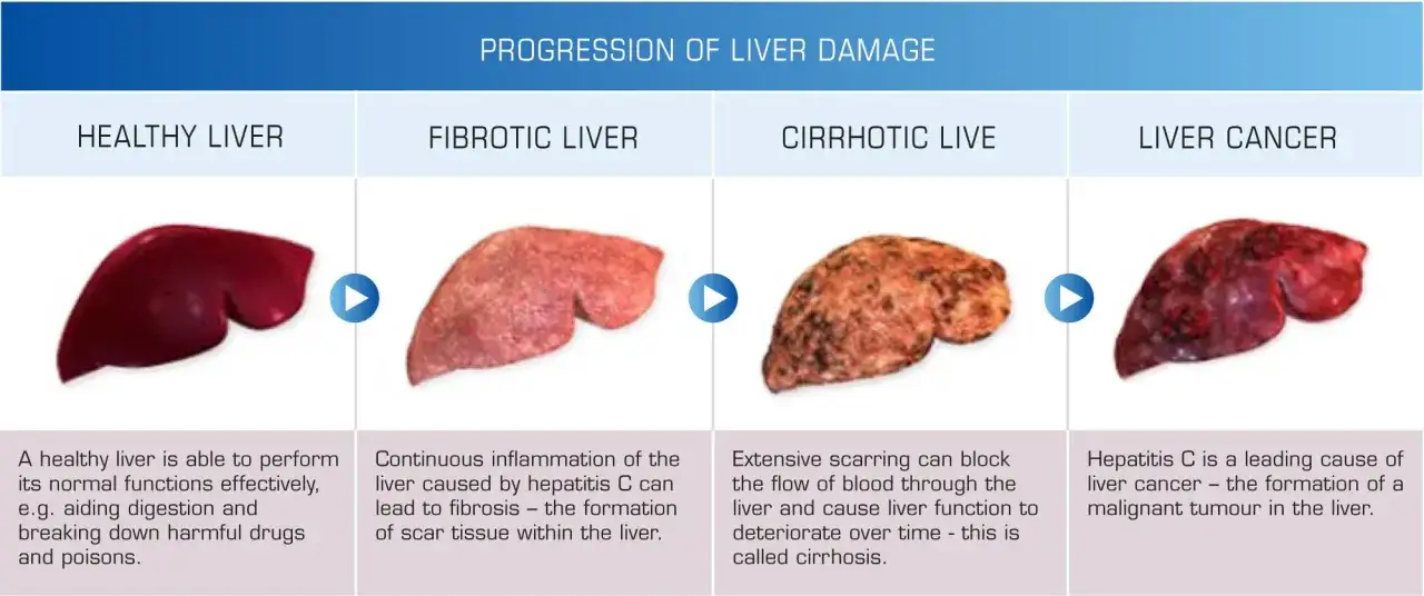 Progressione del danno epatico: fegato sano, fibrotico, cirrotico e con cancro. La cirrosi epatica guarigione &egrave; un percorso complesso.