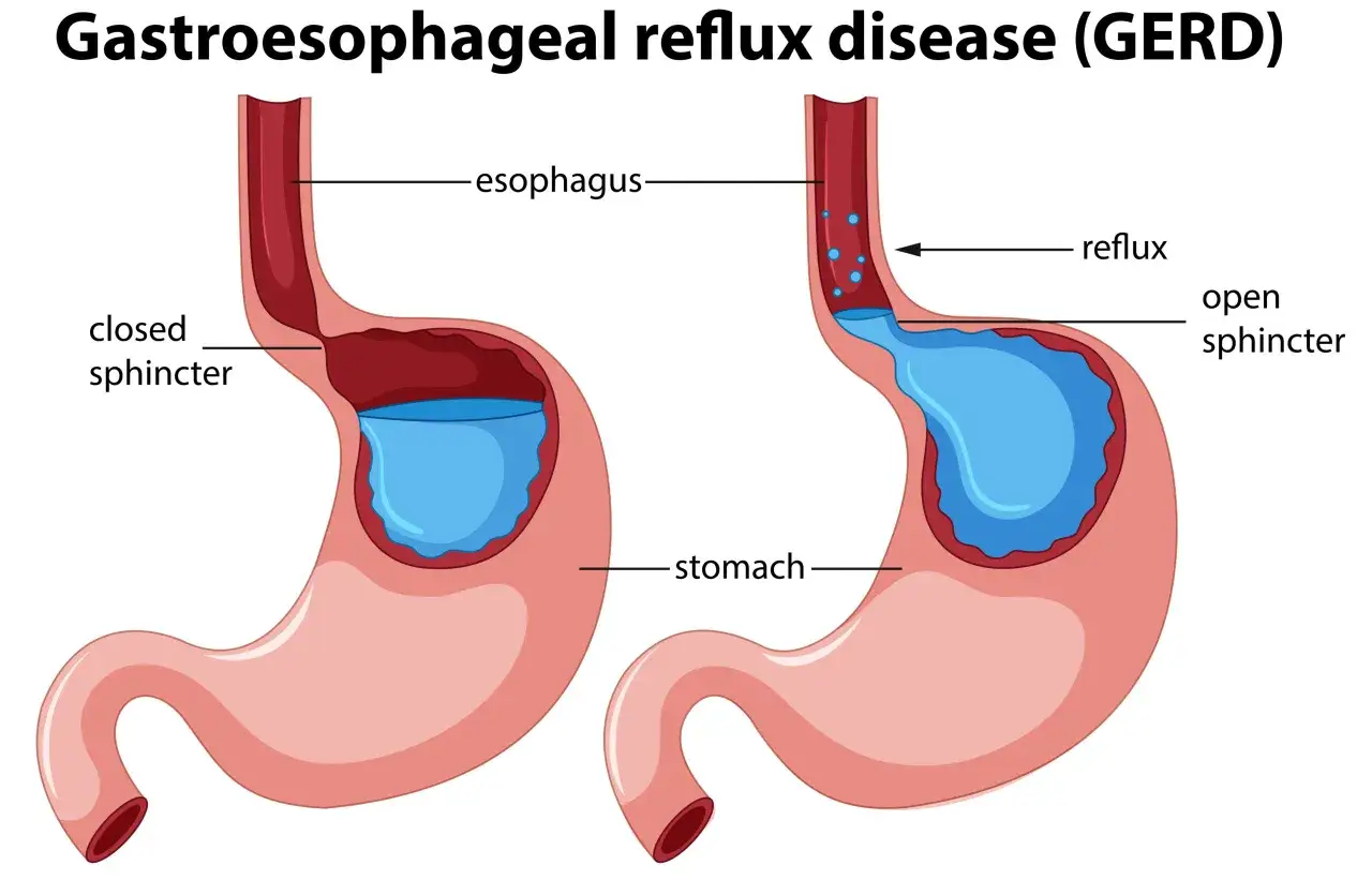 Diagramma del GERD: sfintere chiuso e stomaco normale a sinistra, sfintere aperto con reflusso di acido nello stomaco e nell'esofago a destra, causa di tosse da reflusso.