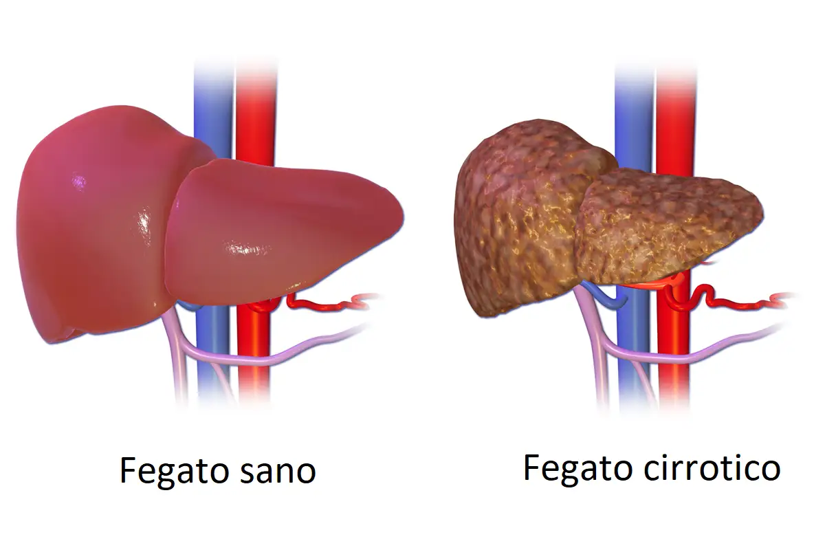 Fegato sano a sinistra, fegato cirrotico a destra. La cirrosi epatica mostra sintomi terminali con un fegato danneggiato e nodulare.