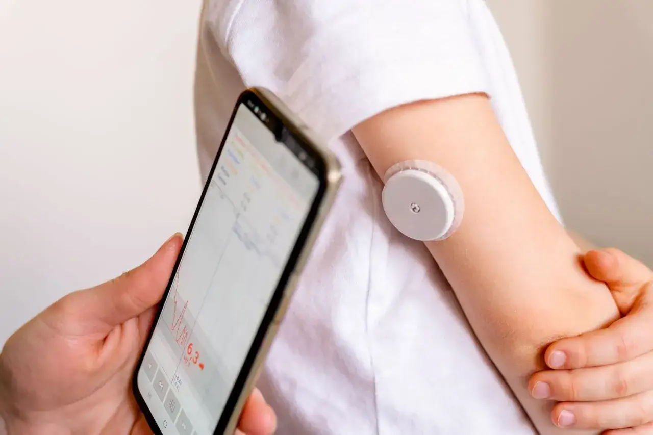 Un sensore sul braccio e uno smartphone mostrano i dati dei misuratori glicemia ultima generazione, per un monitoraggio continuo e discreto.