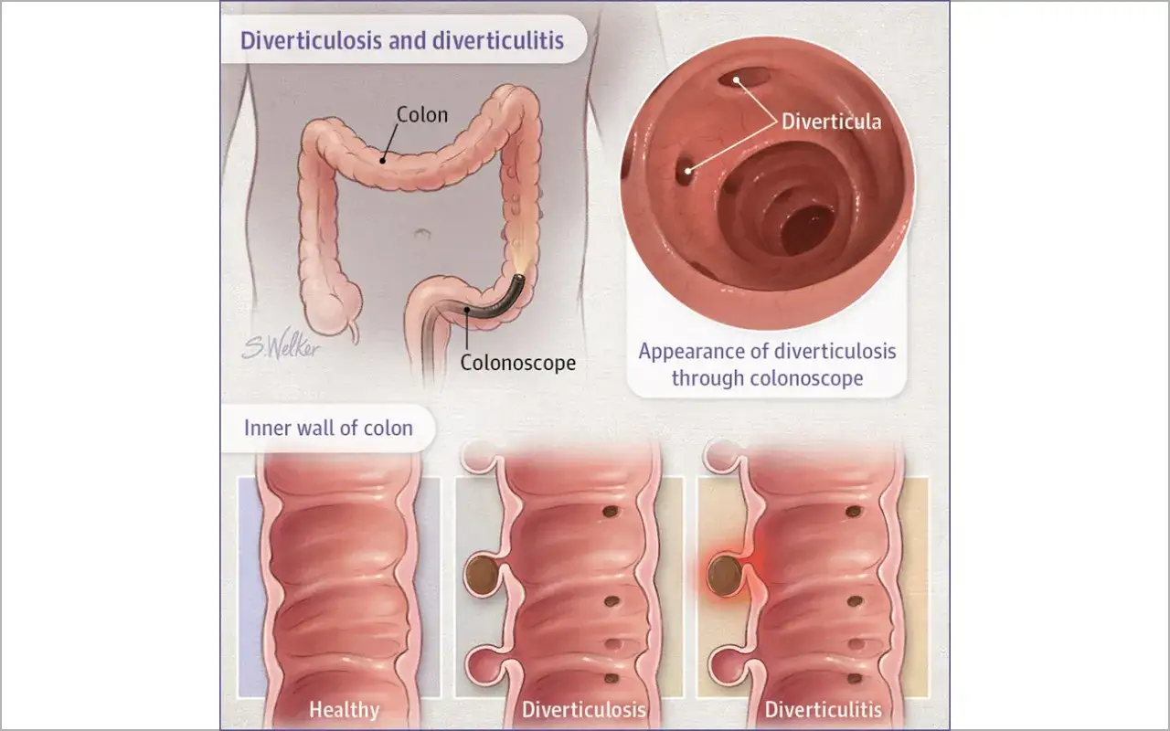 Illustrazione che spiega cosa sono i diverticoli: il colon sano, con diverticolosi e diverticolite.