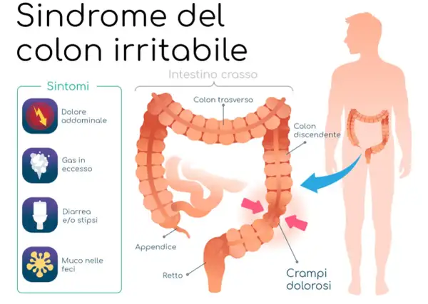 Illustrazione della sindrome del colon irritabile con sintomi: dolore addominale, gas, diarrea/stipsi, muco. Una dieta depurativa colon irritabile può aiutare.