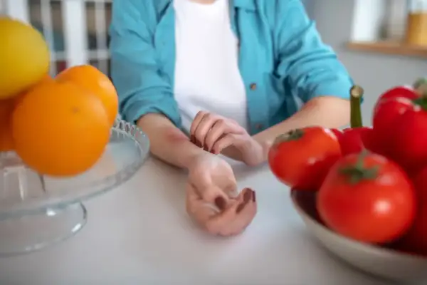 Donna si gratta il braccio arrossato, circondata da frutta e verdura, suggerendo una dieta disintossicante per orticaria.